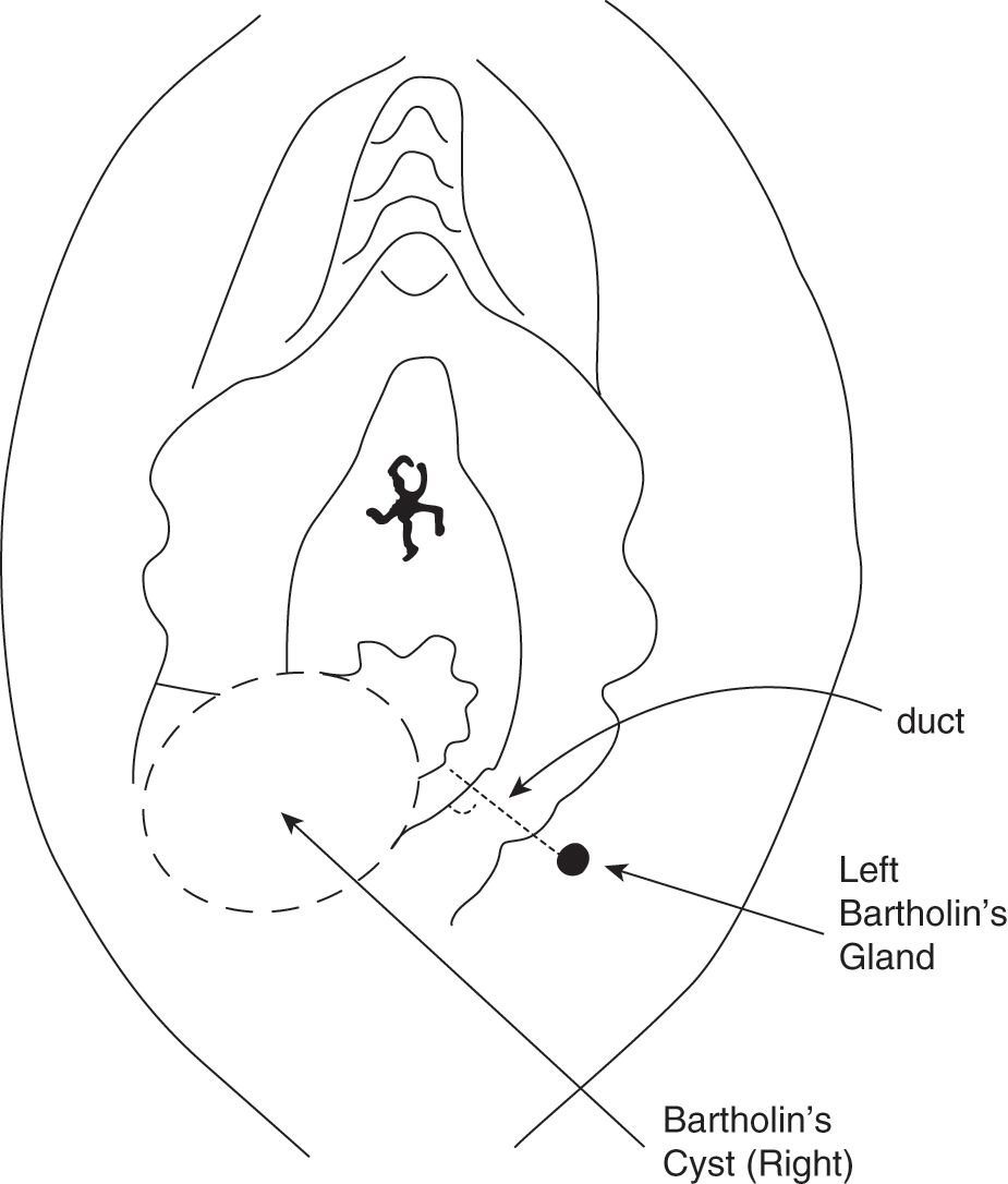  Patient for recurring bartholins abscess by complete excision of cyst wall. - picture